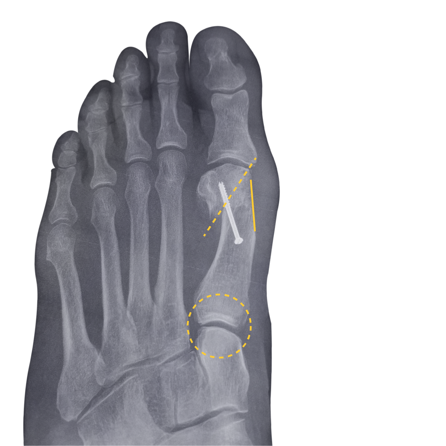 Bunion Surgery Advanced 4D Bunion Surgery